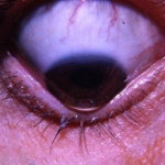 Keratoconus-with-Munsons-sign-USA-1965