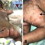 Síndrome de piel escaldada inducido por chikunguña perinatal