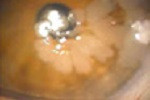 Neoplasia intraepitelial corneal