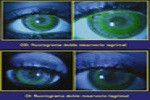 Ortoqueratología y moldeado  corneal