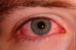 Superficie ocular- ojo rojo