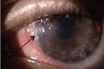 infección corneal