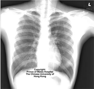 Imágenes radiológicas de pneumonía atípica. Universidad Príncipe de Gales de Hong Kong