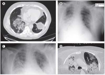 Radiografías y tomografías computarizadas de tórax de paciente con MERS-Co