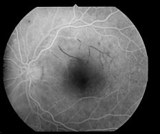 retinopatía diabética