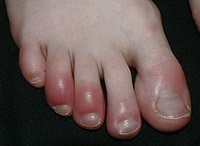 sabañones en los dedos de los pies