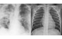 radiografía imagenología pulmón
