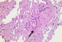 micelios de Aspergillus en tejido cerebral de paciente covid