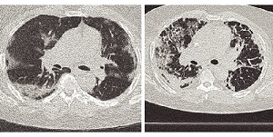 hallazgos radiológicos pulmón