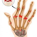 artritis-reumatoide-150x150