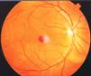 alteraciones-maculares-asociadas-con-hipotensores-oculares-lipidicos
