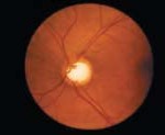 hipertension-ocular-y-glaucoma