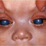 glaucoma infantil