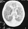 Scanner Cerebral con daño