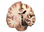Alzheimer cerebro 150px
