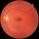 retina y nervio óptico