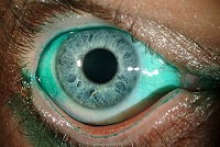 diagnóstico de ojo seco