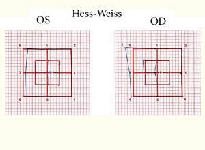 Hess-Weiss test en diplopía binocular