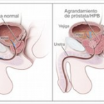 Próstata normal e hiperplasia prostática benigna (HPB). Una próstata normal no obstruye el flujo de la orina desde la vejiga. El agrandamiento de la próstata ejerce presión sobre la vejiga y la uretra, y obstruye el flujo de la orina