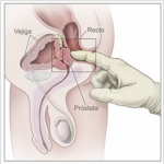 Examen rectal digital (ERD). El médico inserta un dedo dentro de un guante lubricado en el recto y palpa la próstata para determinar si existe alguna anomalía