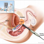 Ecografía transrectal. Se inserta una sonda de ecografía en el recto para examinar la próstata. La sonda hace rebotar ondas sonoras en los tejidos corporales para producir ecos, los cuales forman una ecografía (imagen computarizada) de la próstata