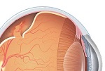 desprendimiento de la retina 150px