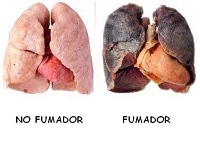 Pulmones de fumador
