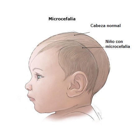 Microcefalia niño